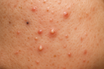Acne/fet